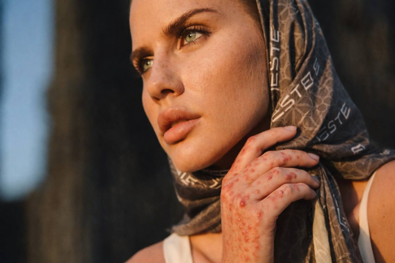 Аллергическая сыпь